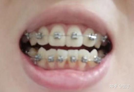 成人爆齿矫正视频,视频解析矫正技巧与效果