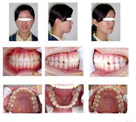 如何拔成人磨牙视频,轻松掌握成人磨牙拔除步骤详解