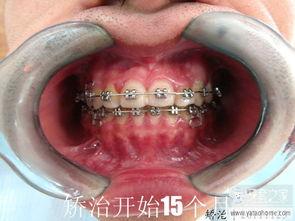 外国成人拔牙视频播放,真实视频带你了解拔牙手术细节