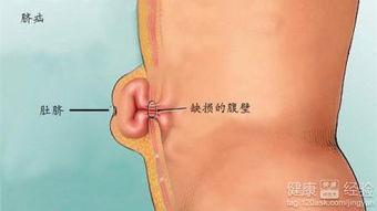 成人脐疝检查视频讲解,诊断与护理要点