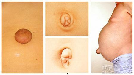 成人脐疝检查视频讲解,诊断与护理要点