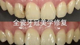 成人修牙视频过程大全,成人修牙全过程视频教程汇总