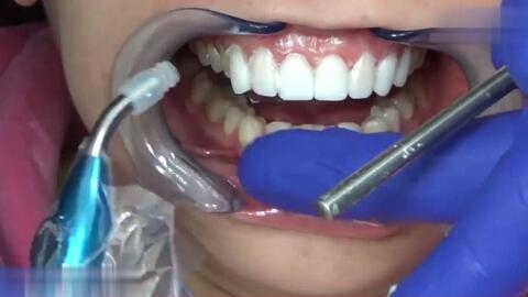 成人修牙视频过程大全,成人修牙全过程视频教程汇总